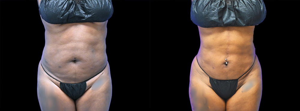 Lipo 360 Before and After