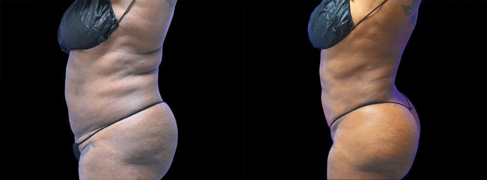 Lipo 360 Before and After