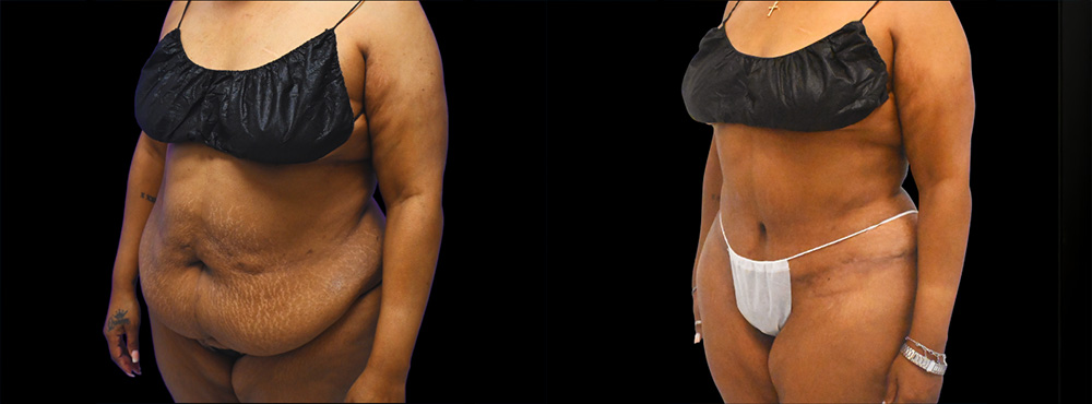 Tummy Tuck Before and After