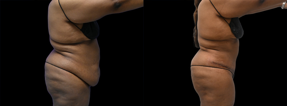 Tummy Tuck Before and After