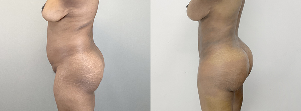 BBL Before and After