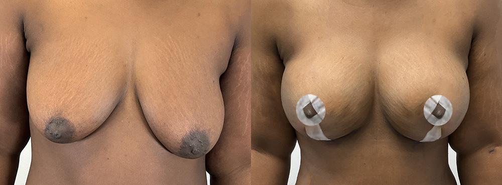 Breast Lift  Before and After