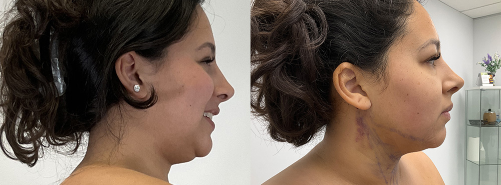 Chin Lipo Before and After in Miami