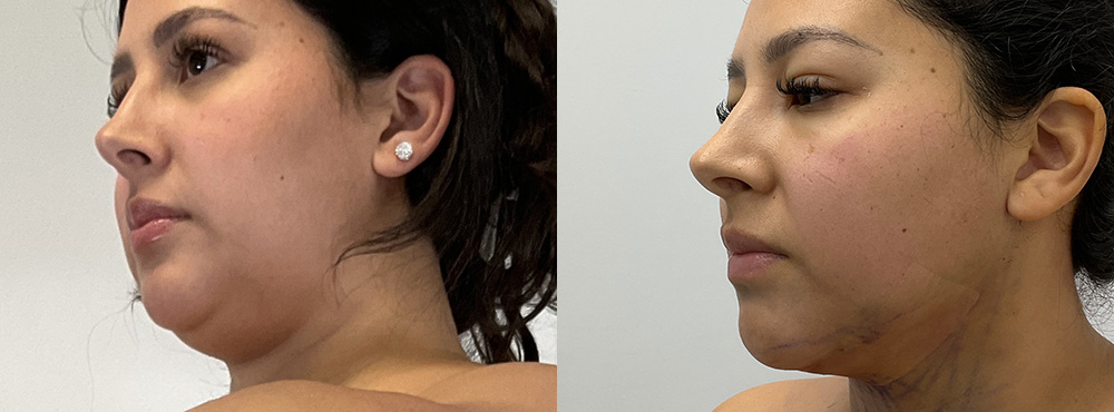 Chin Lipo Before and After in Miami