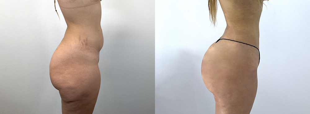 BBL  Before and After