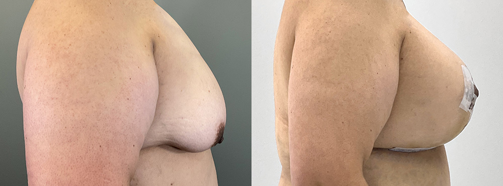 Breast Lift  Before and After