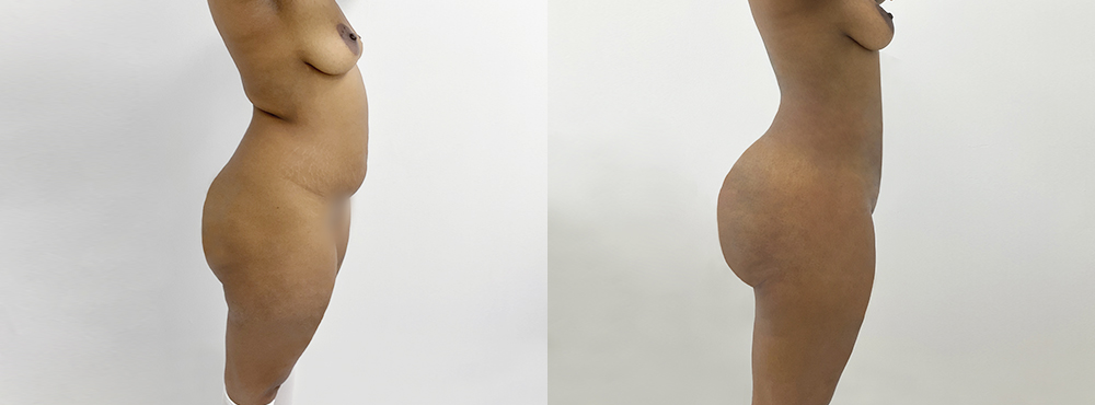 BBL Before and After