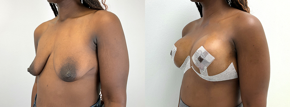 Breast Lift Before and After