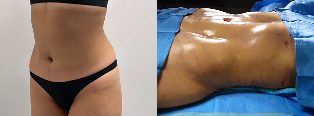 Brazilian Butt Lift Before and After