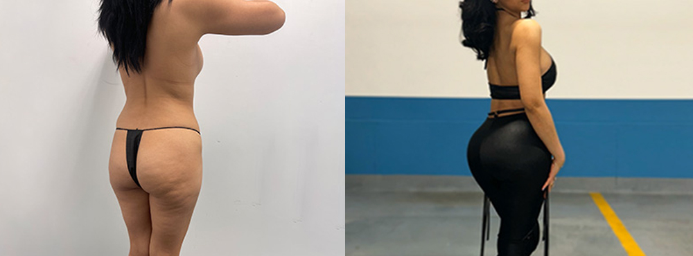 Brazilian Butt Lift Before and After