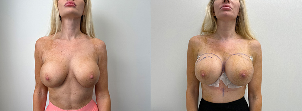 Breast Augmentation Before and After