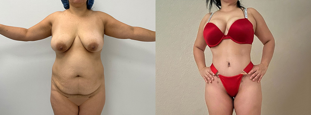 Tummy Tuck Before and After