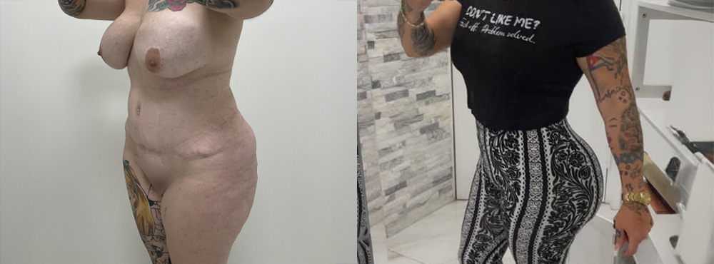 But Lift Before and After