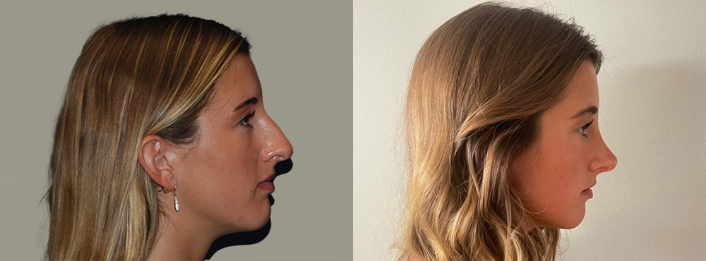 Rhinoplasty Before and After