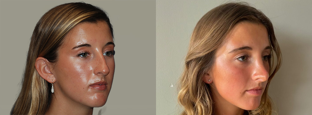 Rhinoplasty Before and After