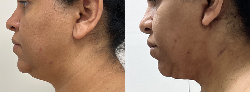 chin lipo before and after