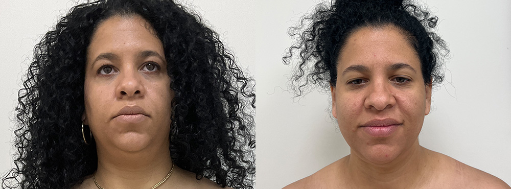 chin lipo before and after