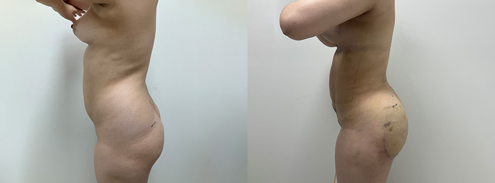 Mommy Makeover Before and After