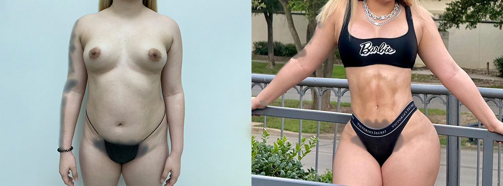 Mommy Makeover Before and After