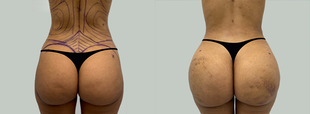 Brazilian Butt Lift Before and After