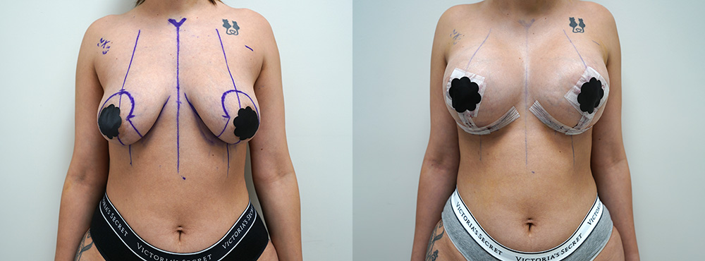 Breast Lift Before and After