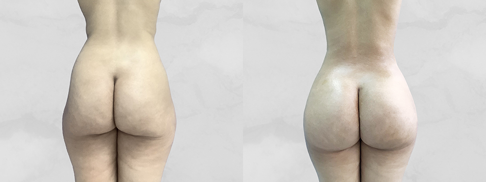 BBL before and after