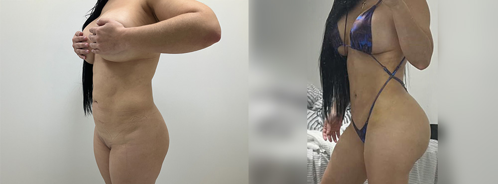 BBL before and after in miami