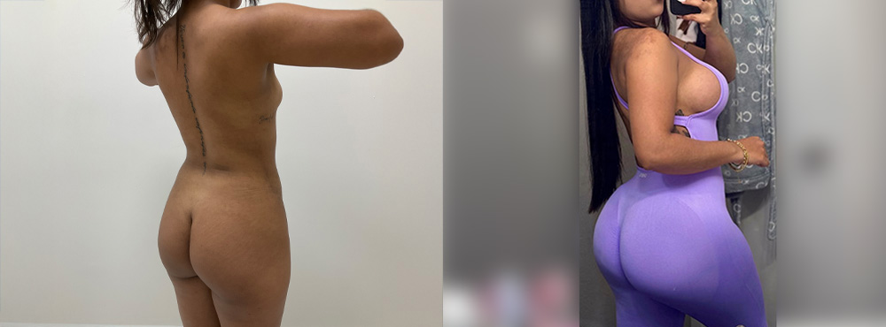 Butt Lift Before and After