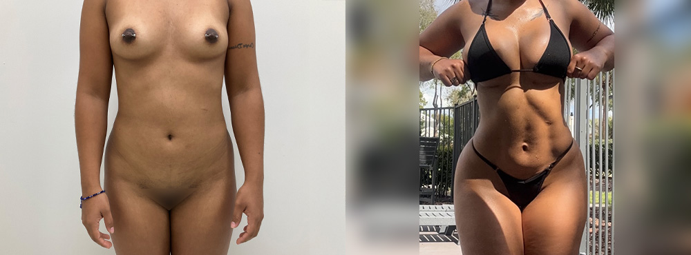 Butt Lift Before and After