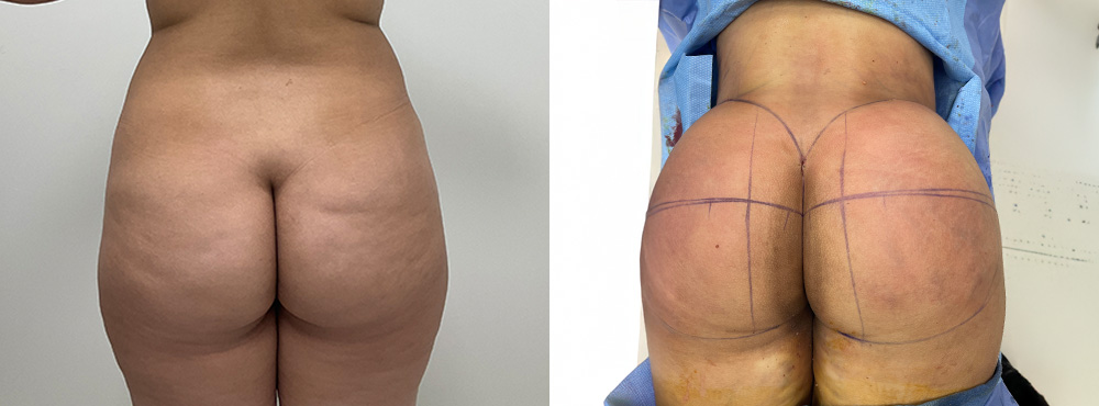 BBL before and after