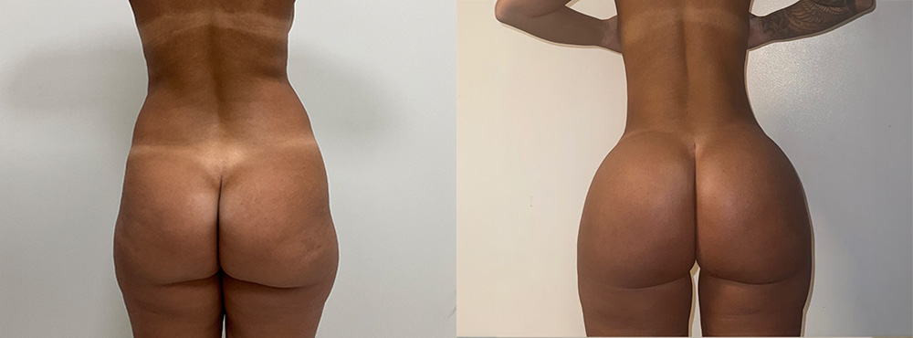 BBL Before and After