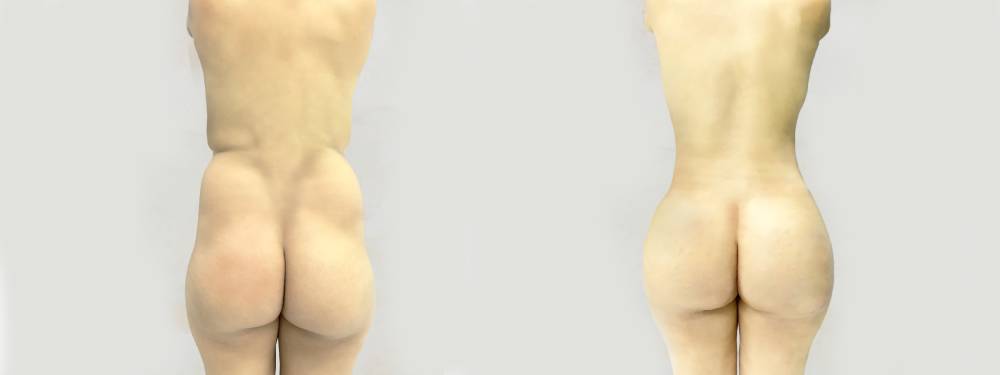 BBL before and after