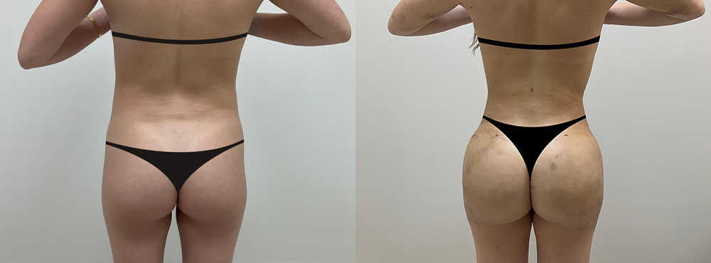 BBL Before and After