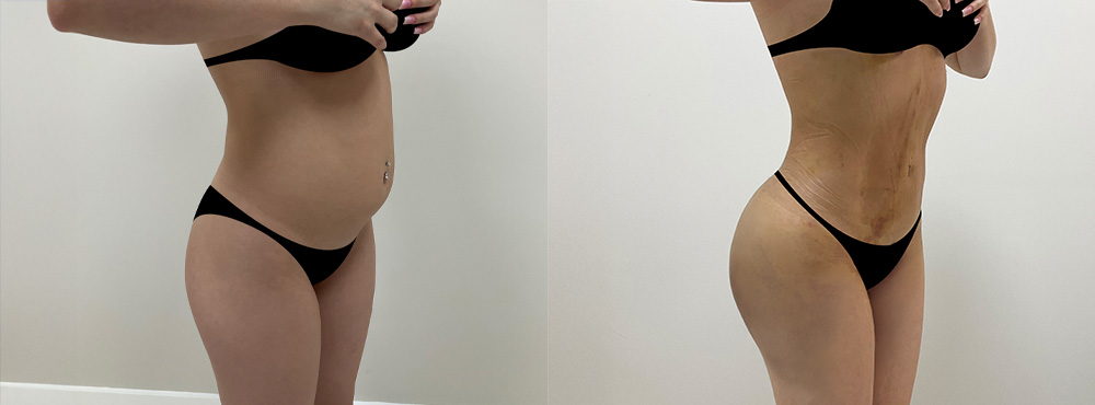 BBL Before and After