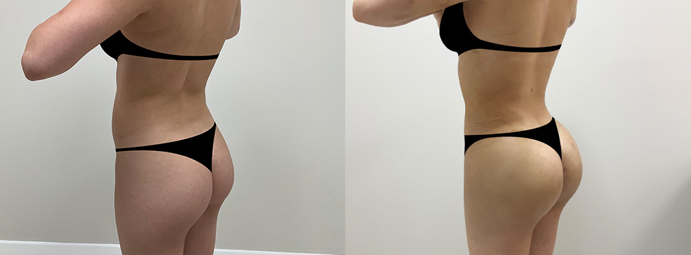 BBL Before and After