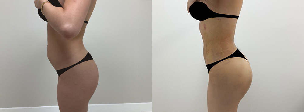 BBL Before and After