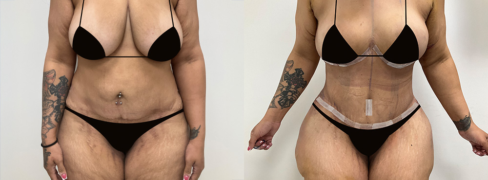 Mommy Makeover Before and After