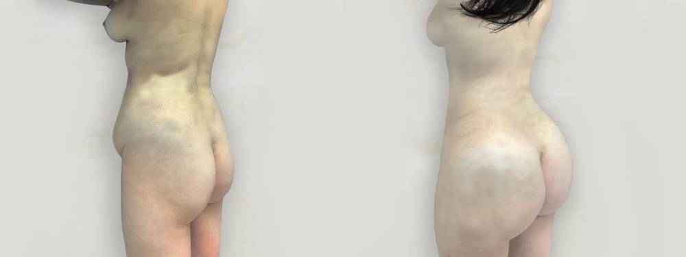 BBL before and after