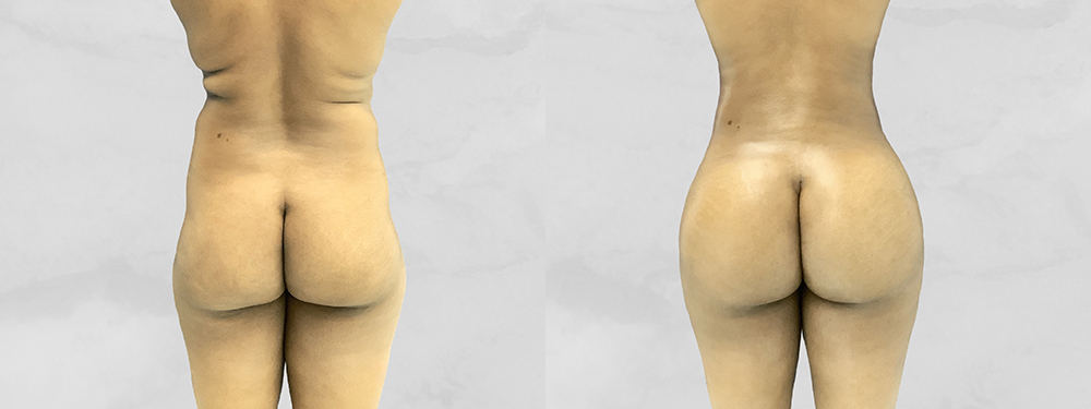 BBL before and after