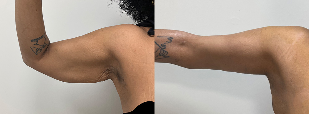 Arm Lift Before and After in miami
