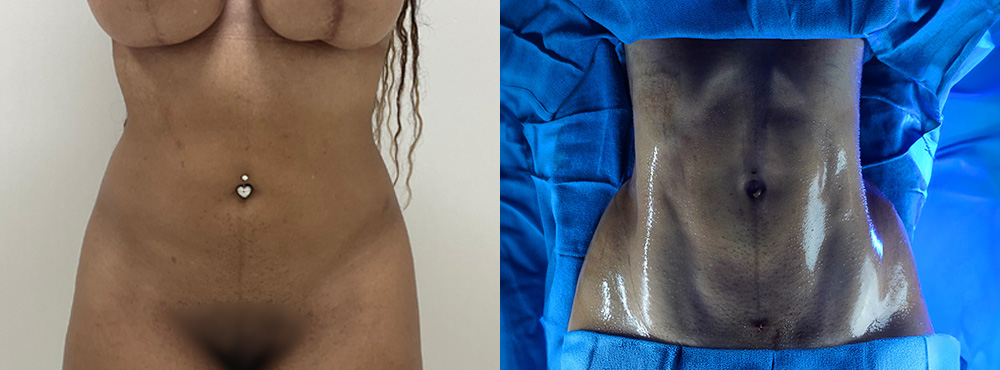 Liposuction Before and After