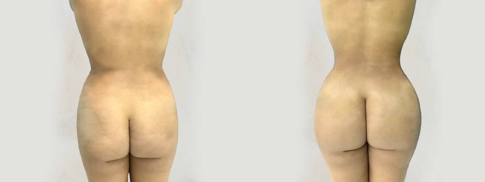 BBL before and after