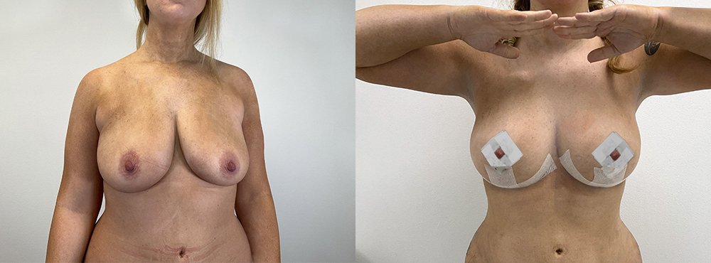 Breast Lift Before and After