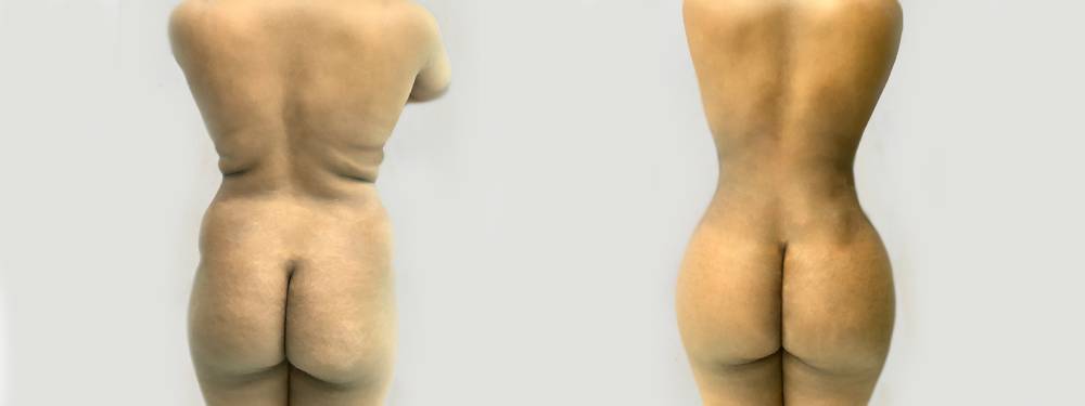 BBL before anf after