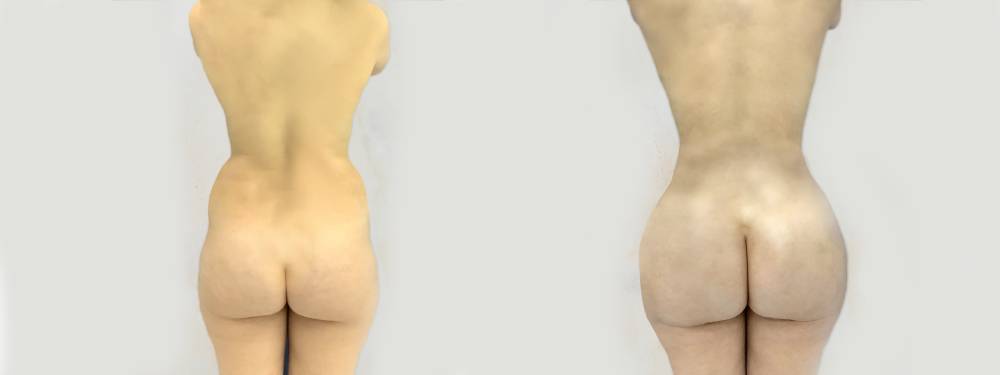 BBL  before and after