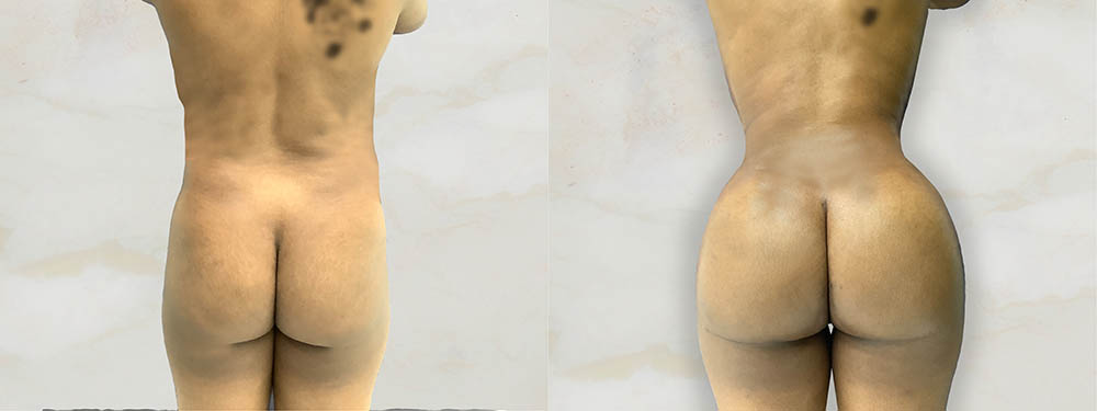 BBL before and after