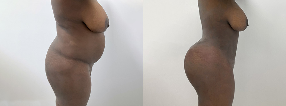 BBL Before and After