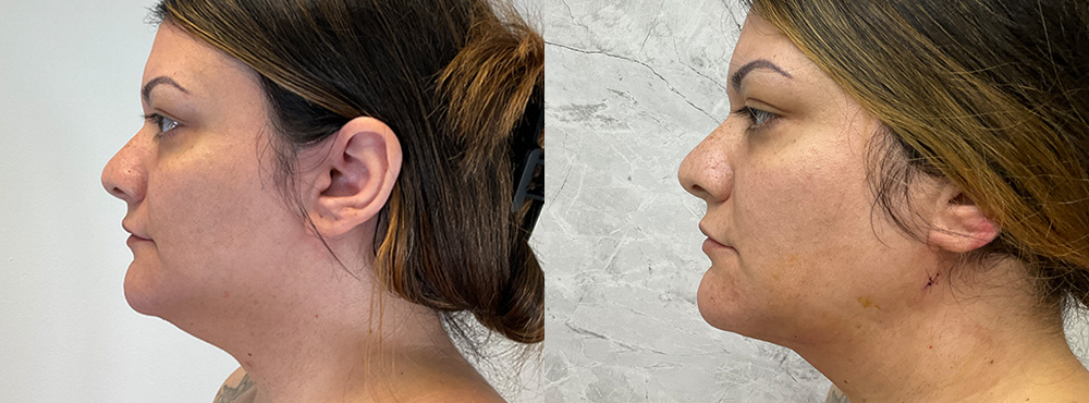 Chin Lipo before and after