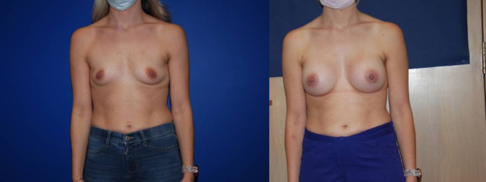Breast Augmentation