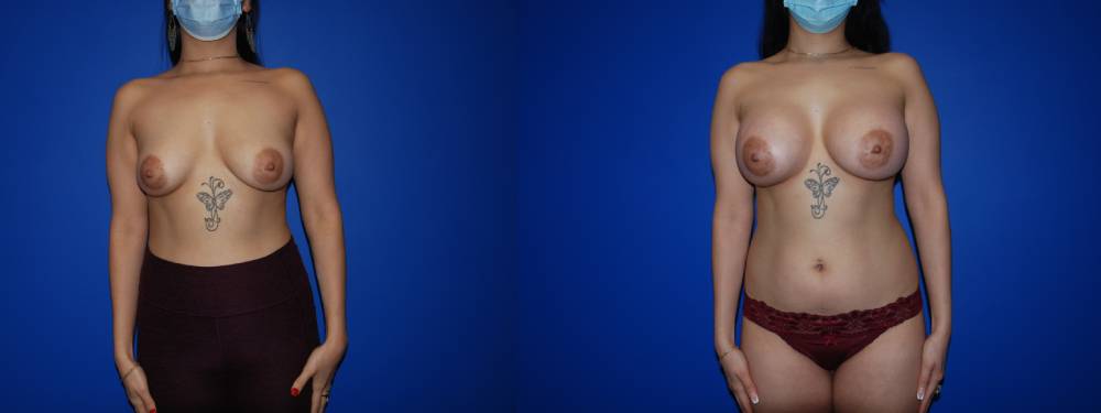 Breast Augmentation